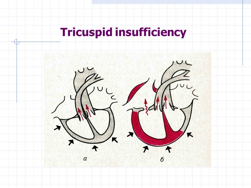 Tricuspid insufficiency